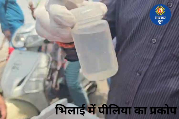 भिलाई सेक्टर-7 में पीलिया का प्रकोप, 22 बच्चों में लक्षण, 2 आईसीयू में भर्ती